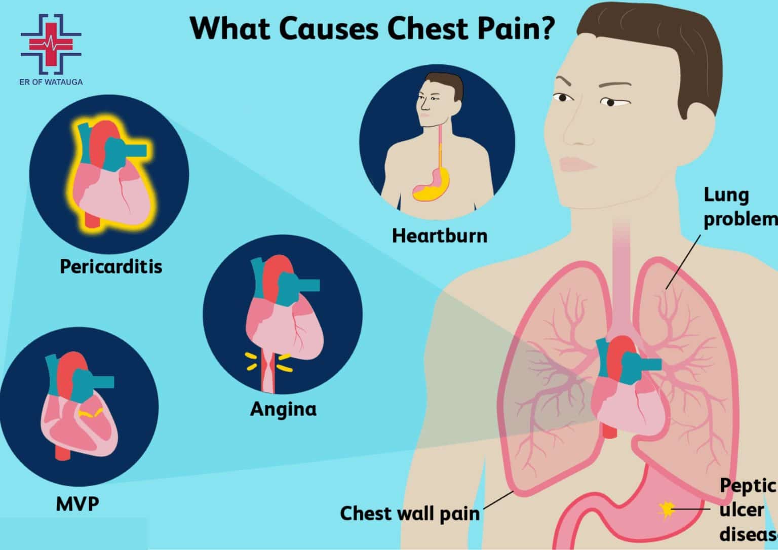 Random Sharp Chest Pains How Do I Know If My Chest Pain Is Serious? Er Of Watauga