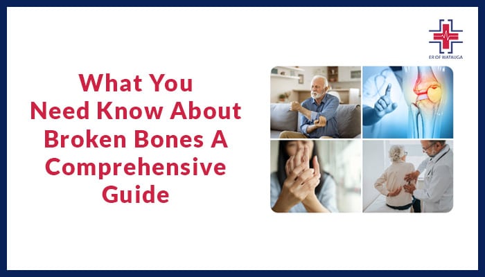 What You Need Know About Broken Bones