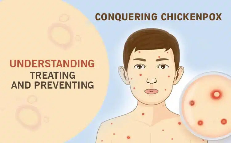 Conquering Chickenpox