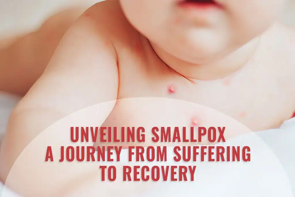 Unveiling Smallpox A Journey From Suffering To Recovery