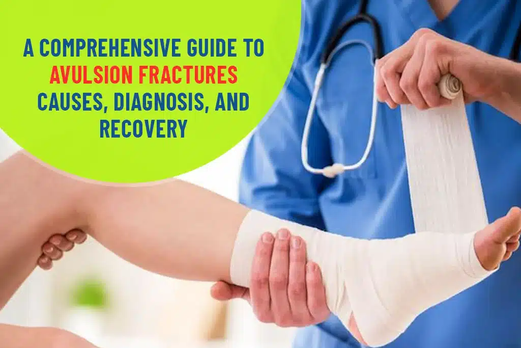 A Comprehensive Guide to Avulsion Fractures Causes Diagnosis, and Recovery