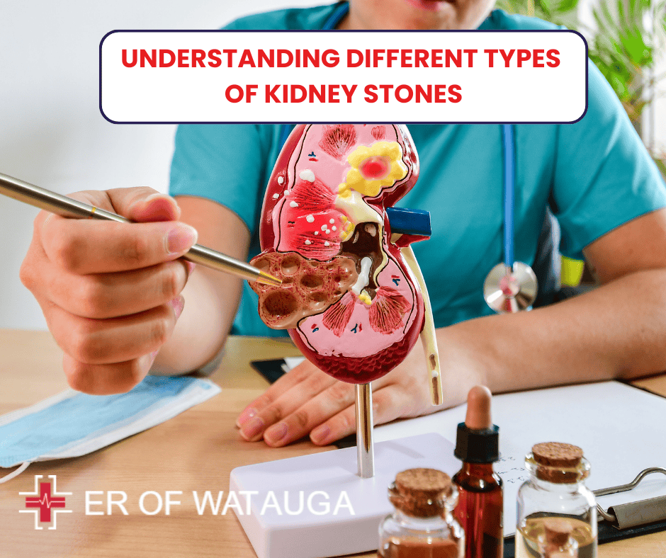 Understanding Different Types of Kidney Stones at er of watauga