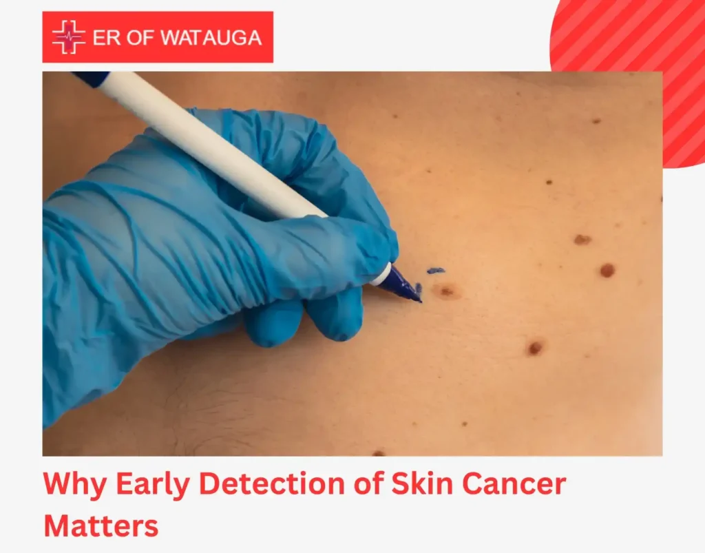 Why Early Detection of Skin Cancer Matters