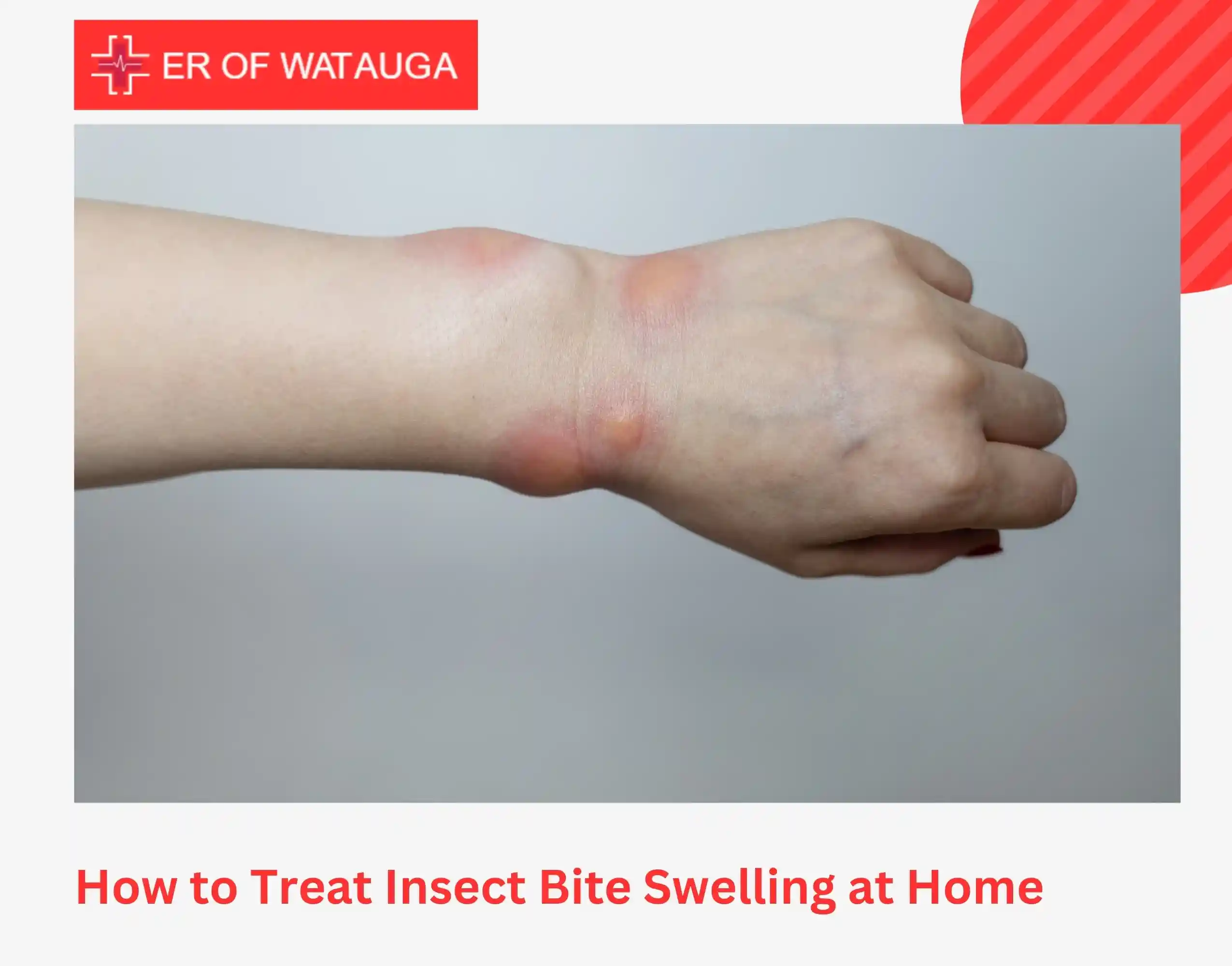 How to Treat Insect Bite Swelling at Home