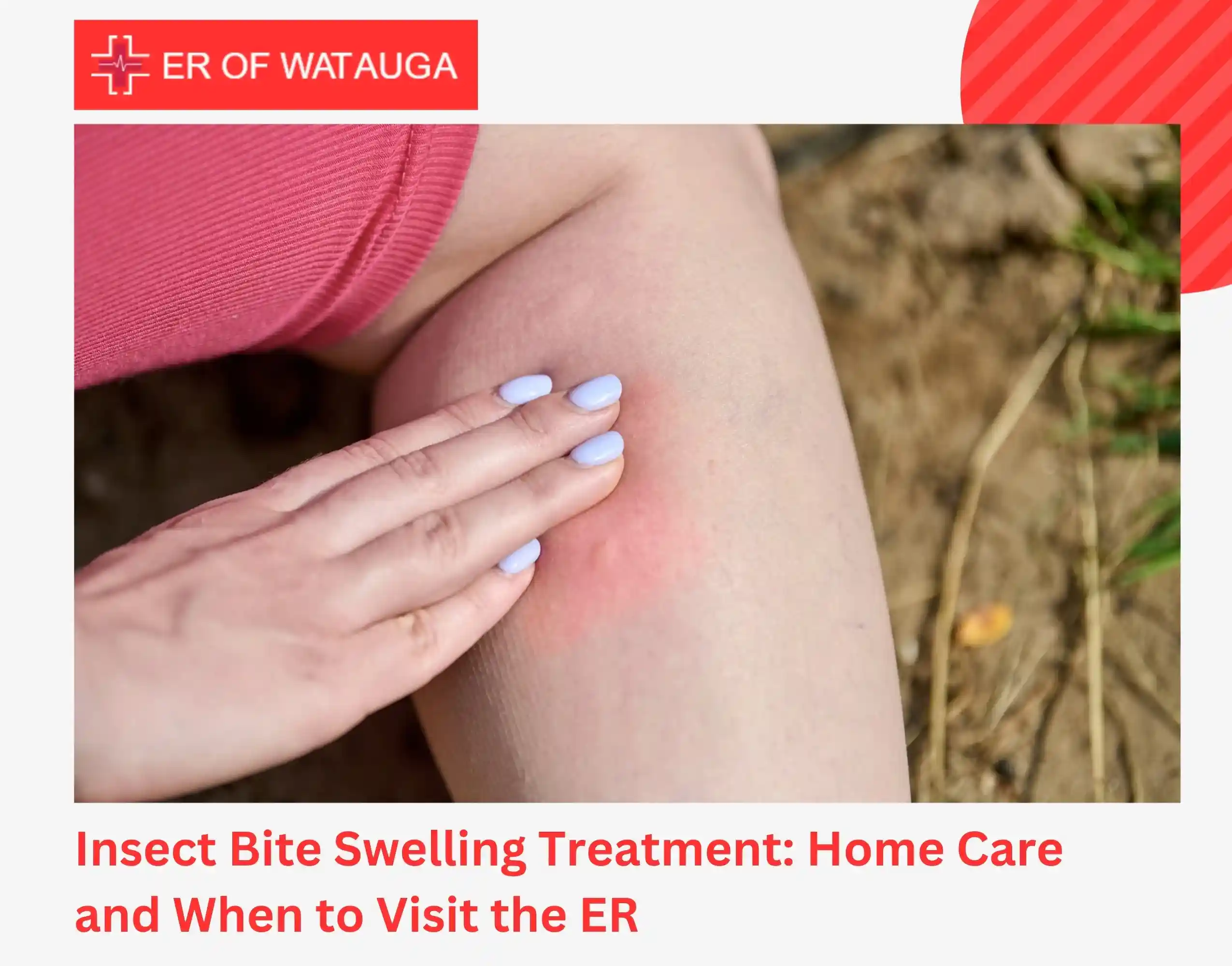 Insect Bite Swelling Treatment Home Care and When to Visit the ER