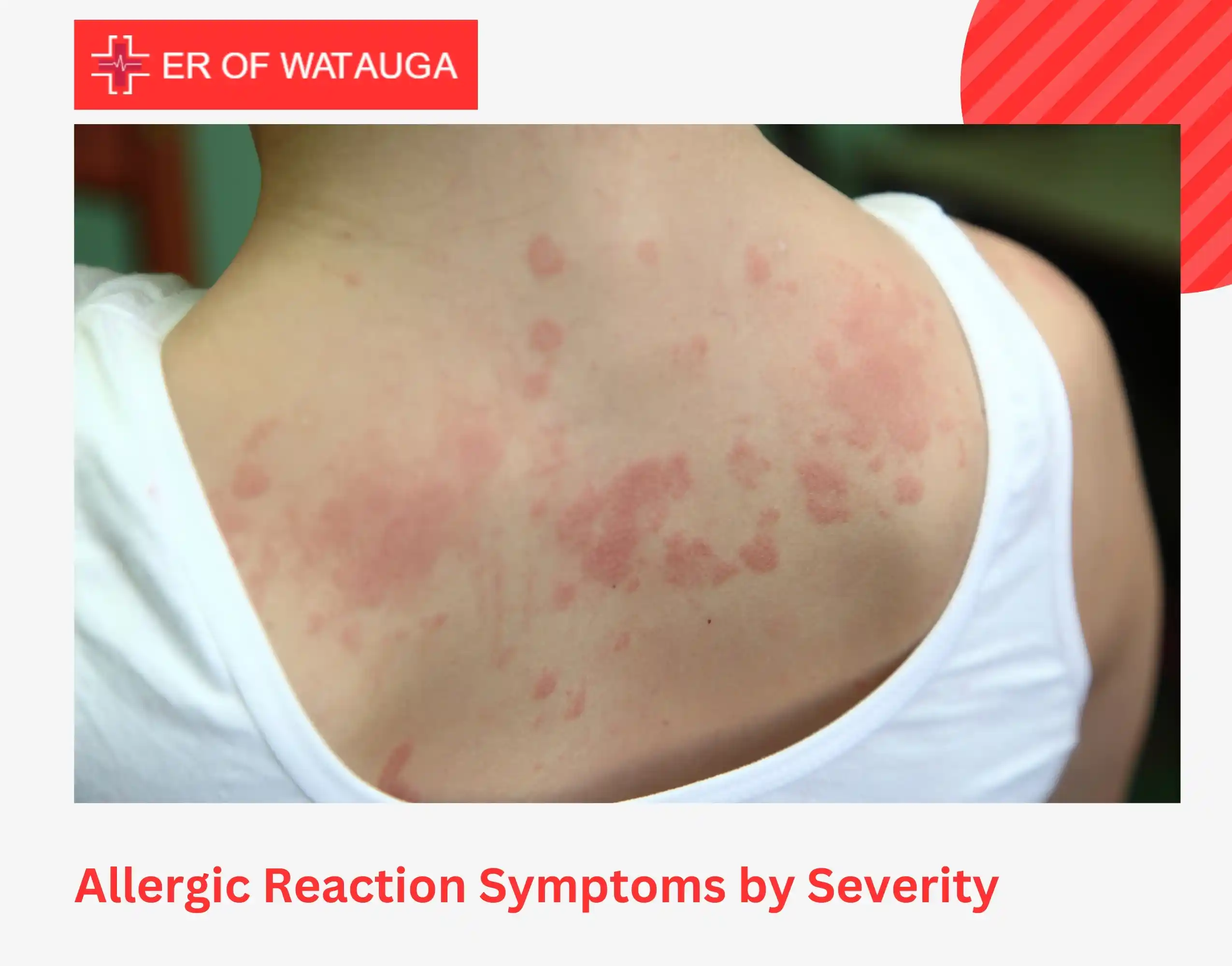 Allergic Reaction Symptoms by Severity