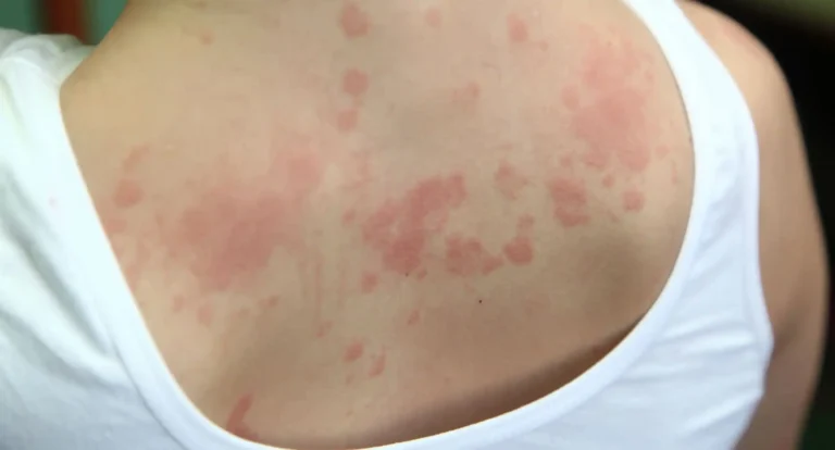Rashes