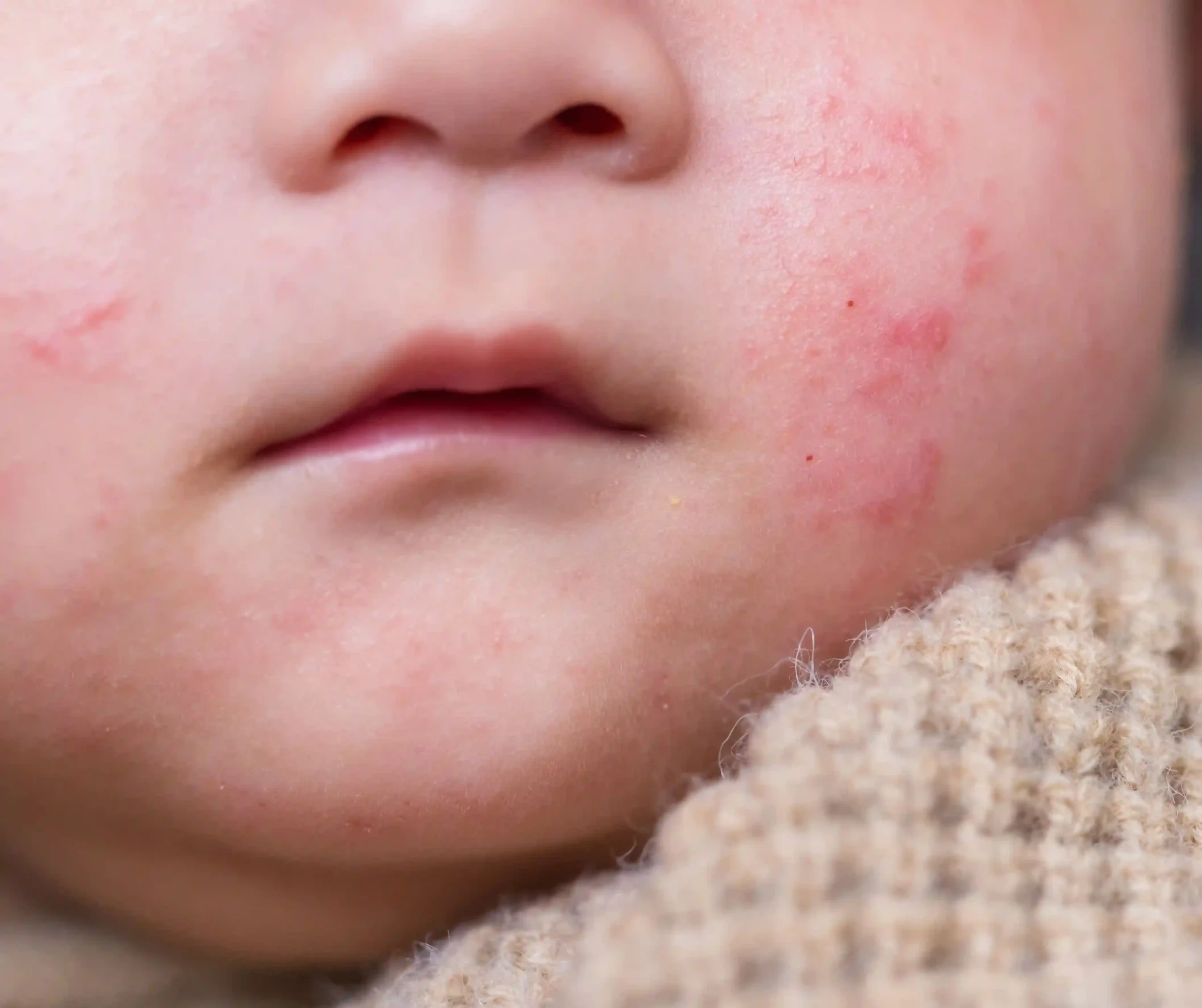 Rashes