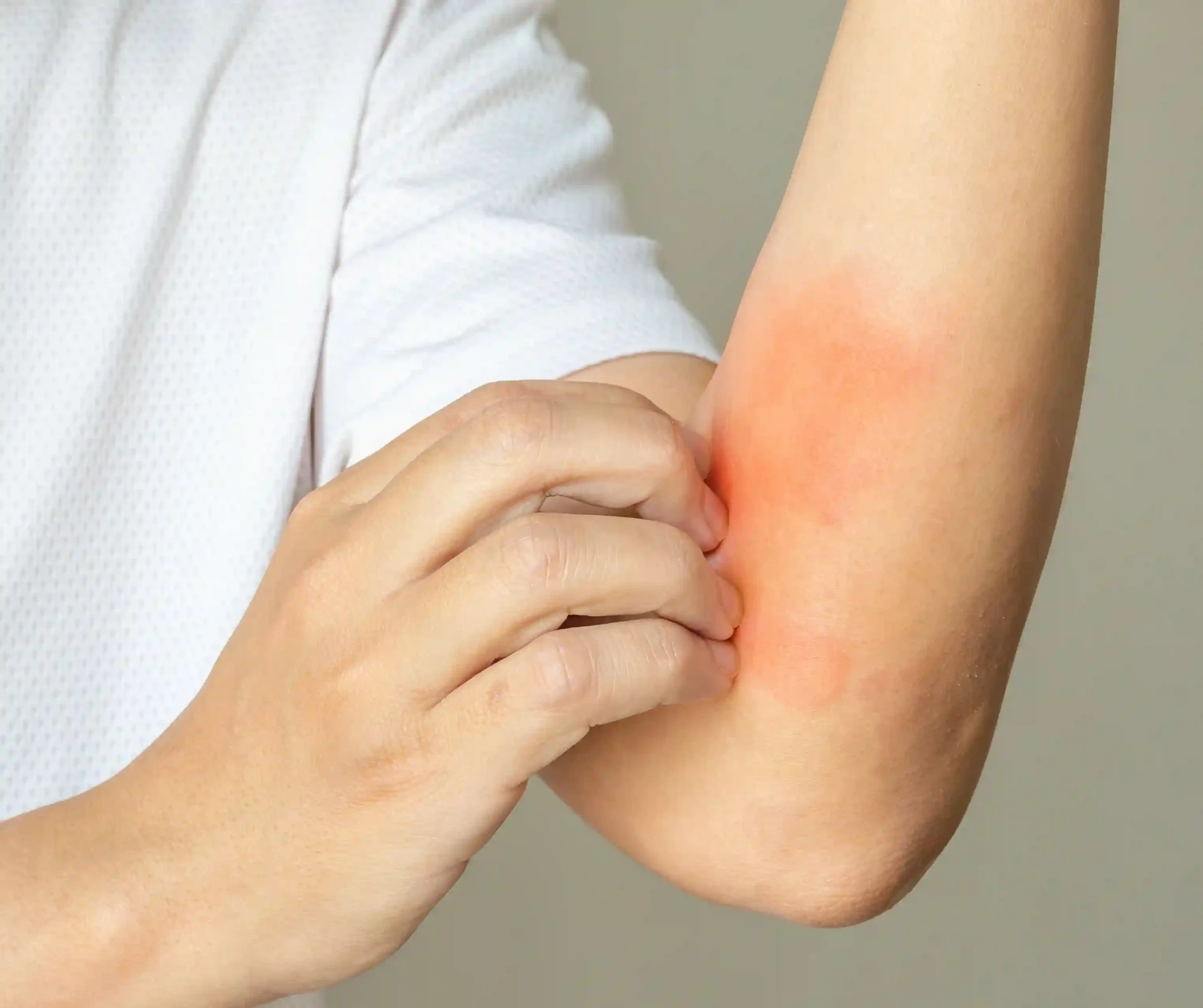 Rashes