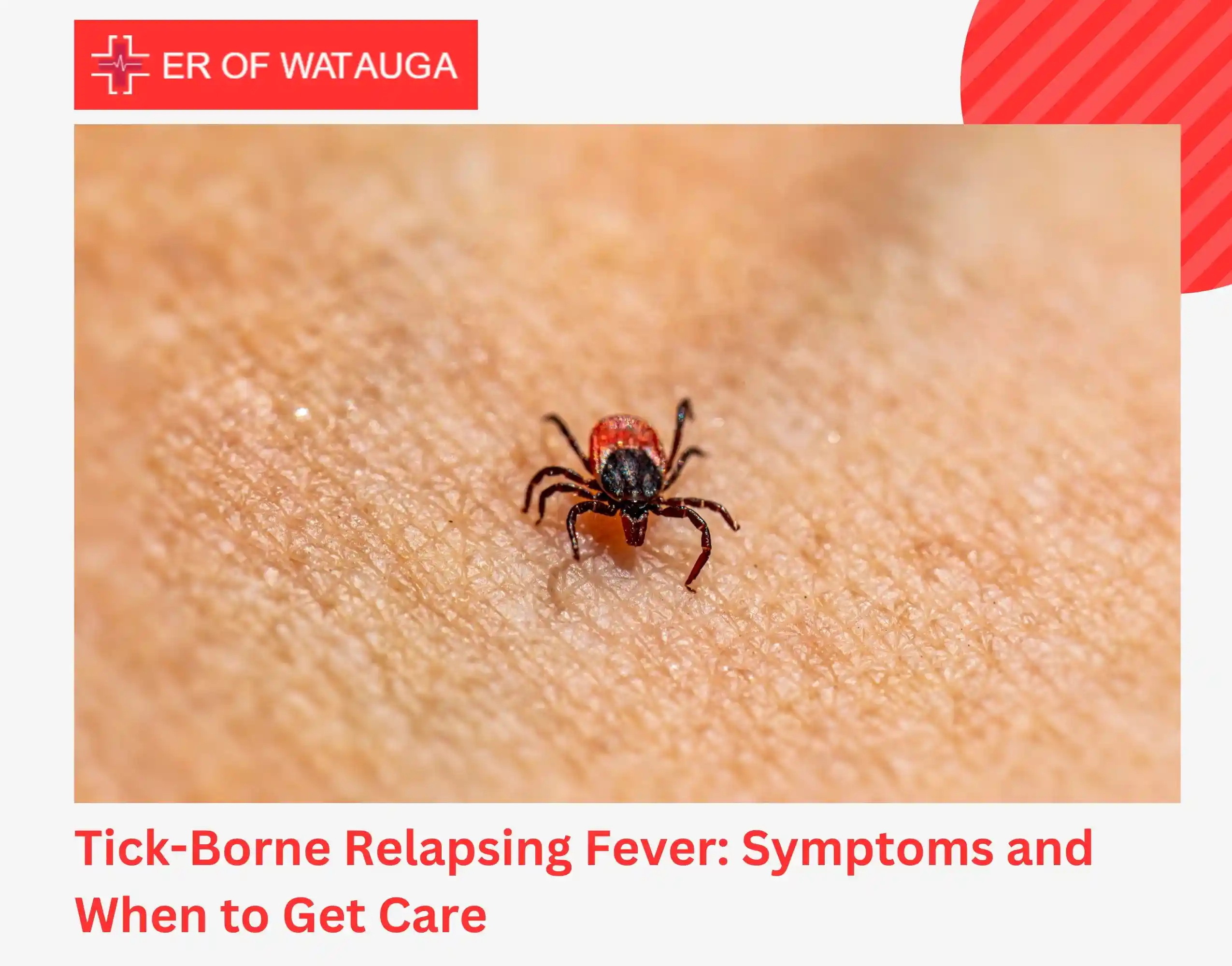 Tick-Borne Relapsing Fever Symptoms and When to Get Care