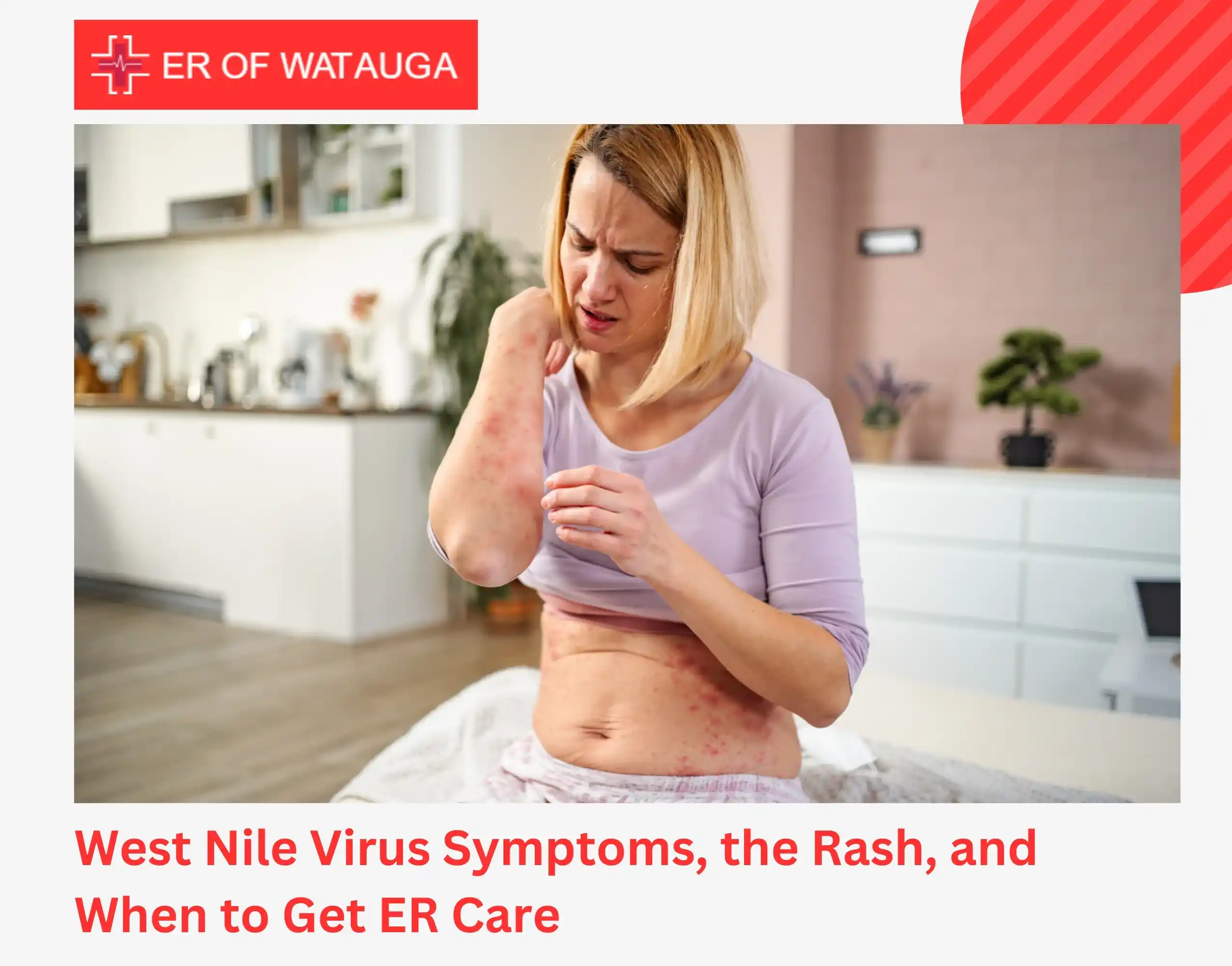 West Nile Virus Symptoms, the Rash, and When to Get ER Care