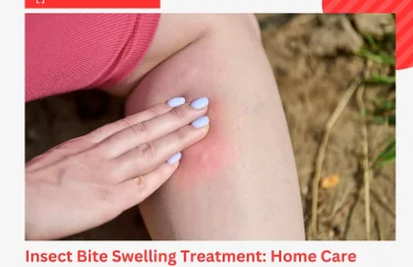 Insect Bite Swelling Treatment Home Care and When to Visit the ER