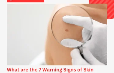 What are the 7 Warning Signs of Skin Cancer